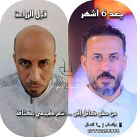 زراعة شعر • تقنية الزفير • القادسية بغداد
