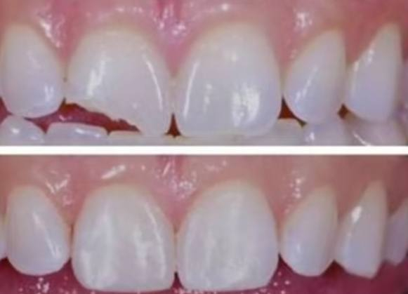 السلام عليكم ورحمه الله وبركاته
الي عندة تسوسات بأسنانه تشبه هاي الصور او كسر بلأسنان الامامية يراسلني على هذا الرقم واتساب ***********علما بأن العلاج مجاني وبأشراف دكاترة مختصين وبعيادات نظيفة تضمن راحة المريض
