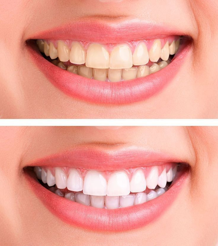 Marvis toothpaste🤍
معجون مارفيس إيطالي الصنع،
من مميزاته يحارب اصفرار الاسنان والتسوس والرائحه المزعجه😍
كل الناس حاليا تقريبا اتعاني من اصفرار الاسنان بسبب الشاي او القهوه لذلك وفرنالكم هذا الحل القوي👆🤍
🌸ضيفوا معجون أسنان مارفيس لروتين العنايه بأسنانكم
#عنايه #معجون_مارفيس
#روتين #عنايه #يومي
#شباب_بنات
#اكسبلور #اكسبلور_فولو


**إذا كنت صاحب هذا الإعلان وتريد حذفه لأي سبب، رجاءا أرسل رسالة إلى الدعم الفني**