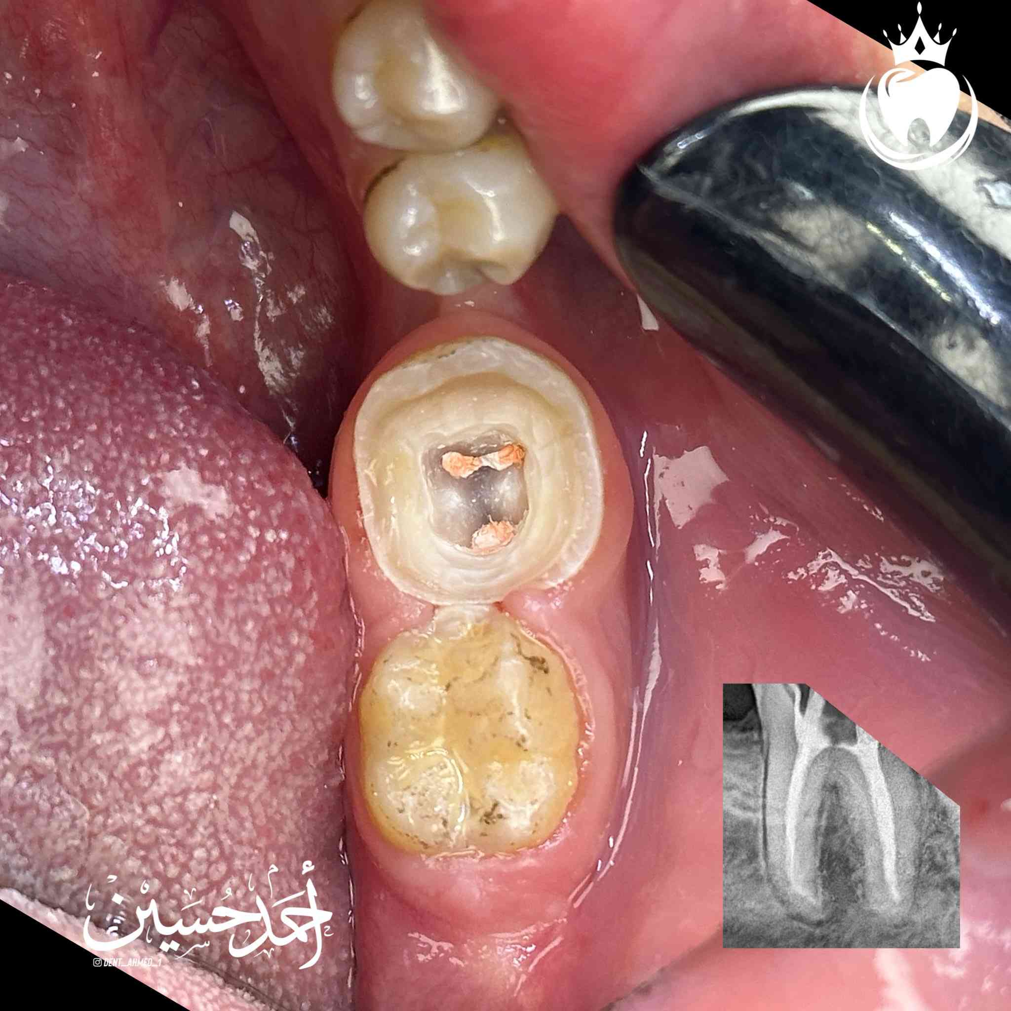 هذه الرحاة كان مصيرها القلع حسب قرار الطبيب السابق لكن قررنا نحافظ عليها كون الجزء المتبقي بعد ازالة التسوس يعتبر مناسب نوعا ما و رغبة المراجع في الحفاظ على هذا السن  و بناءََ على ذلك بدينا رحلتنا لأرجاعها الى وضعها الطبيعي😎
شرح الخطوات اسفل الصور 

الدكتور احمد حسين الطعماوي 
ناحية الزاب - المجمع الطبي الحديث مجاور مرطبات كرزة
الدوام طيلة ايام الاسبوع من الساعة ٣:٣٠ الى الساعة ٨:٠٠ مساءا
للحجز و الاستفسار : ***********
