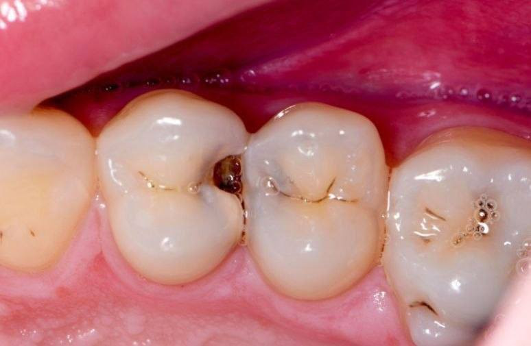 مرحبا منو عنده هيج تسوسات ومحتاج يحشيهن يتواصل ويايه خاص او واتس *********** العلاج مجاني وباشراف اطباء اختصاص داخل عيادات الجامعة المستنصرية
