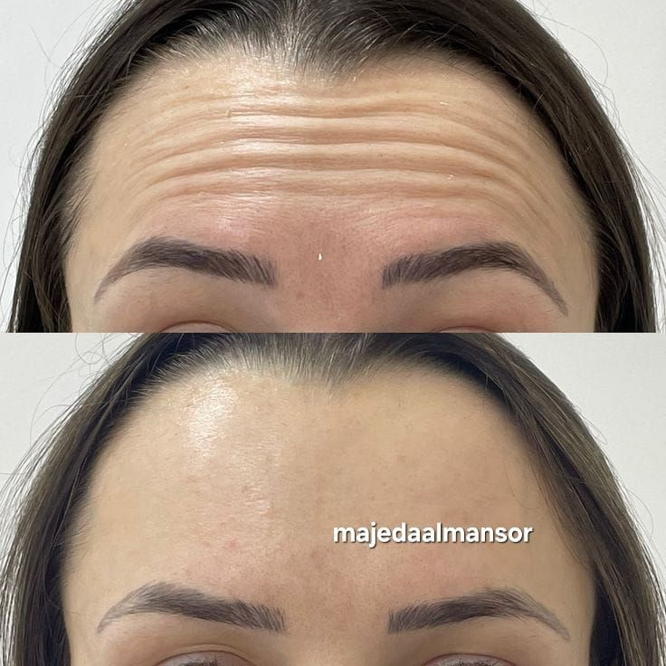 اجمل رسماة  الشفاه 
ازالة التجاعيد شد وامتلاء الوجه 
ازالة تجاعيد اليد 
مواد أمنة واصلية 
الدكتورة  ماجدة المنصور Jojo Alnabeel 
العنوان بغداد الحسينية مقابل السوق الكبير مجاور مرطبات العذراء
مجمع سما الحسينيه الطابق الثاني قسم التجميل والصالون ***********
