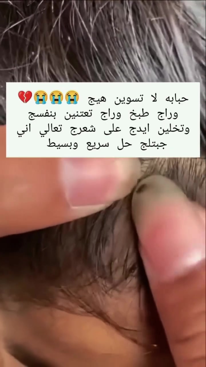 جهاز ازالة القمل🐜 والصئبان والبيوض 🐜
الاسترالي الاصلي 
يشفط القمل والصئبان ويتخلص منهم بكل سهوله 🐜🐜
مو بس القمل والصئبان والبيوض ويشفط القشره ايضاً  😍
علاج لقمل الرأس خالي من المواد 
الكيميائية
. 
. 
#جهاز_القمل
#البصرة_الحله_الموصل_كربلاء_سامراء_الرمادي_دهوك_كركوك_الاعظميه_زيونة_الكرادة_المنصور_الرواد_كورنيش_الزوراء_ #ديالى_ذي_قار_المثنى_القادسية_البصرة_واسط_الانبار_صلاح_الدين_الموصل_ميسان_بغداد_اربيل_السليمانية_دهوك_كركوك_كربلاء_النجف_نينوى #الموصل_العراق_بغداد_البصرة_النجف_الموصل_سولف_سوالف_مصلاوية_عتيقة_موصل_انستا_لمتنه_مصلاوي


**إذا كنت صاحب هذا الإعلان وتريد حذفه لأي سبب، رجاءا أرسل رسالة إلى الدعم الفني**