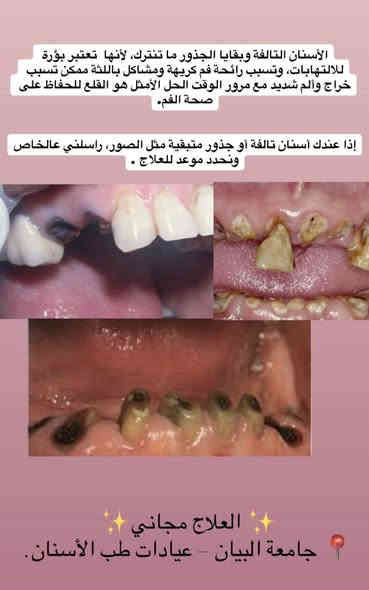 السلام عليكم 
تتوفر علاجات مجانية في عيادات جامعة البيان 🤎

وتكون للحالات التالية:

 •فحص الفم والأسنان.

 •تنظيف الأسنان وإزالة التكلسات والتصبغات.

 •قلع الأسنان التالفة وبقايا الجذور.

 •معالجة الأسنان بالحشوات التجميلية (الضوئية).

 •تعويض الأسنان المفقودة بطقم جزئي.

علماً أن العلاج مجاني بالكامل وبإشراف أطباء اختصاص✨

⭐️ملاحظة مهمة: الالتزام بالنظافة والتعقيم جزء أساسي للحفاظ على صحة الفم والأسنان.

📞 للتواصل على الرقم او الواتساب : ***********

📍 الموقع: عيادات جامعة البيان – شارع المطار – قرب ساحة عباس بن فرناس

📩 لتحديد المواعيد: مراسلتي على الحساب Tuqa Jassim

مقدماً أهلاً وسهلاً بيكم 🌸✨
