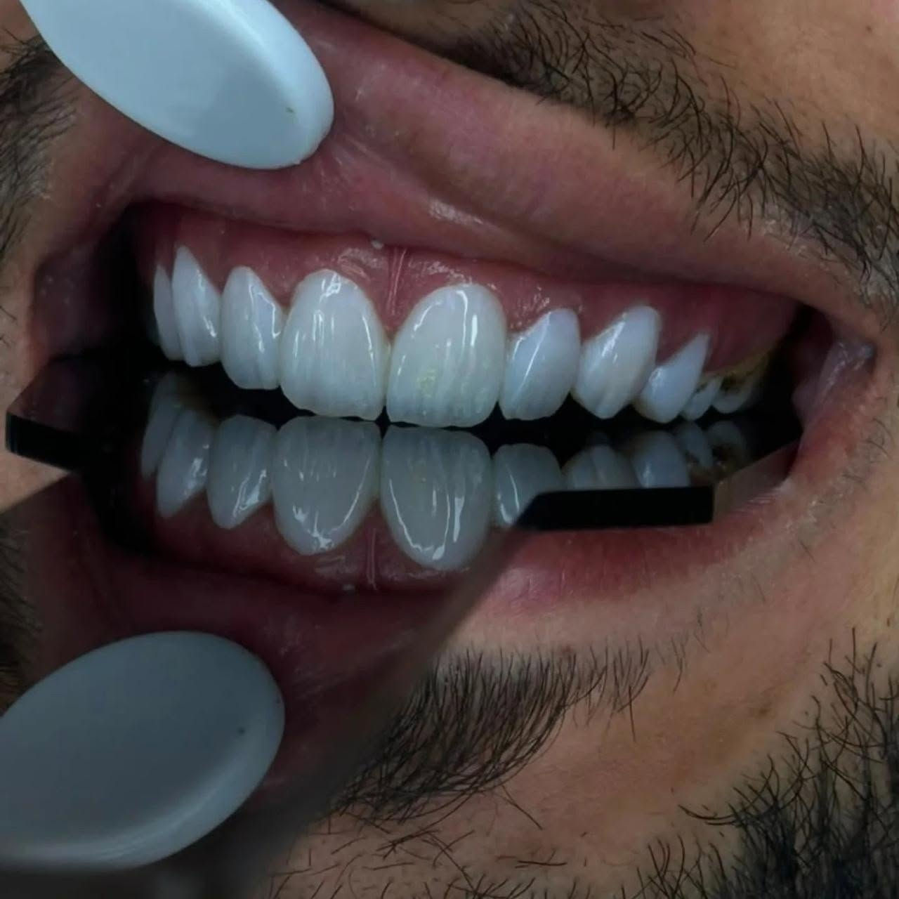 "الابتسامة المثالية حلم كل إنسان، اكتشف جمال ابتسامتك بخدماتنا."

متواجدين لخدمتكم طيلة أيام الأسبوع #الشركة_الطبية_العالمية 

🔻
🏢 العنوان / بغداد _ بسماية _ الشارع العام  . مجاور ماركت الغدير 
فوق مطعم بي تاون
📲 للحجز والاستفسار 
***********
#مركز_بسماية_لطب_وتجميل_الاسنان
