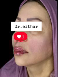 شد وجه • فلر شفة • الكوت الهوره