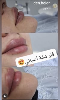 فلر شفة • تجميل الأسنان • دكتورة هيلين