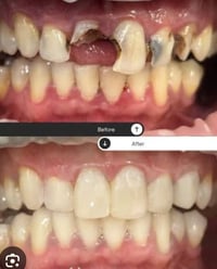 كلية الحكمة • تبييض اسنان • حشوات وقلع