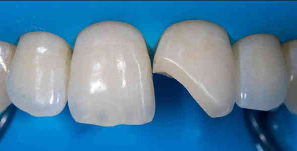 السلام عليكم 
يتوفر حشوات ضوئية مجانية في كلية المنارة لهاي الحالات:

1.سن امامي مكسور
2. سن خلفي متسوس من الجوانب

اللي عنده يكدر يتواصل ويانه : ***********
