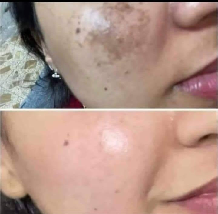 بنات شباب خلطه اسوي الوجه كيمر الله شاهد نمش تصبغات وهاي تجارب خلال يومين تزلغك زلغ


**إذا كنت صاحب هذا الإعلان وتريد حذفه لأي سبب، رجاءا أرسل رسالة إلى الدعم الفني**