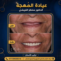 تعويض الأسنان • فك علوي كامل • عيادة المهجة