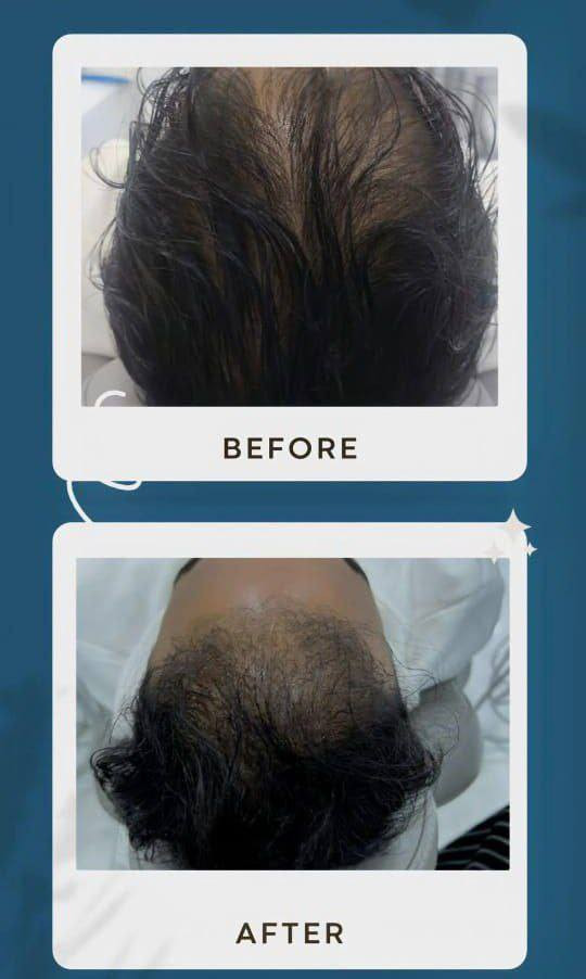 يوجد في عيادة ايفنت لطب الأسنان والتجميل
قسم التجميل لاجراحي 
يشمل 
الفلر
البوتكس 
ابر نظارة 
محفزات كولاجين  إبرة الكالسيوم وغيرها
البلازما والخلايا الجذعية للوجه والشعر 
التغير الشامل
مع نتائج مضمونة

*********** للتواصل بخصوص التجميل
بيجهم على الانستكرام 👇 
https://www.instagram.com/event.clinic?igsh=MTc3NG0ycTdxMjhxYw==
