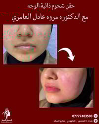 ✨ حقن شحوم الوجه – عرض خاص بسعر 150 ألف فقط 💎 تعبئة الخدود والمناطق ال...