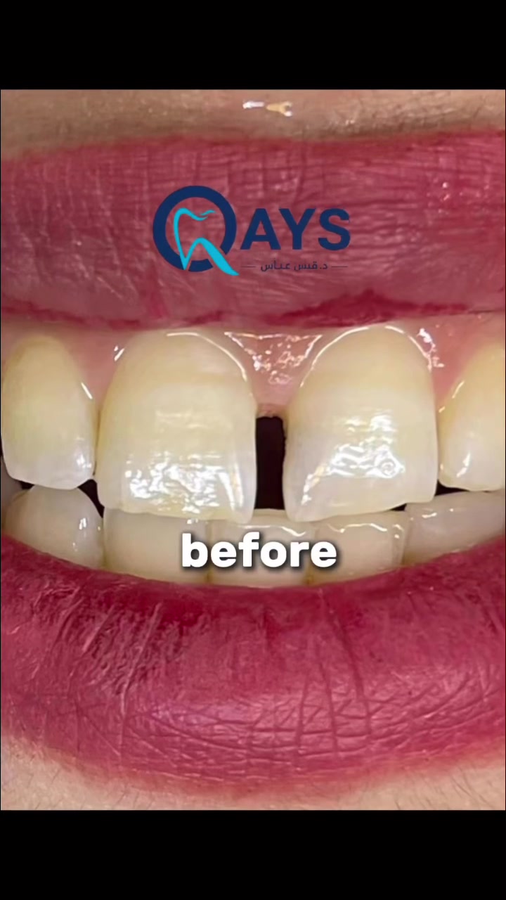 سد فراغات الأسنان الأمامية ✨
نتيجة طبيعية وفورية باستخدام حشوات تجميلية حديثة 🦷

📍عيادة د. قيس عباس الساعدي
حي الجهاد – الشارع التجاري
📞 ***********
 #حشواتتجميلية #دقيس_عباس_الساعدي  #سد_الفرغات #ابتسامة_صحية. #composite
