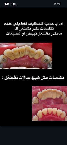 علاج جميع مشاكل الاسنان #مجاناً 

باستخدام احدث الاجهزه وبأشراف دكاتره اختصاص 

للحجز والاستفسار التواصل ع الواتساب ***********

العنوان /الحلة -شارع 40 - مجاور صيدليه سلامتك اولا - فندق الحياة سابقا
