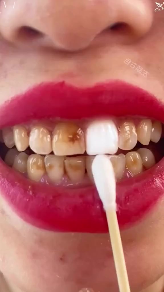 الي يعاني من اصفرار او تسوس الاسنان
او بقع من كثرة التدخين🦷
او شرب الشاي والقهوة والمواد الصبغية
وحاب يرجع اسنانة بيض😍
🤍نقدم لكم منتج ايلهو لتبييض الاسنان
تستخدم حسب الحاجه وليس يوميا

سعر القطعة 4 الاف


**إذا كنت صاحب هذا الإعلان وتريد حذفه لأي سبب، رجاءا أرسل رسالة إلى الدعم الفني**