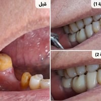 جسر زركون • تركيب جسر • خانقين