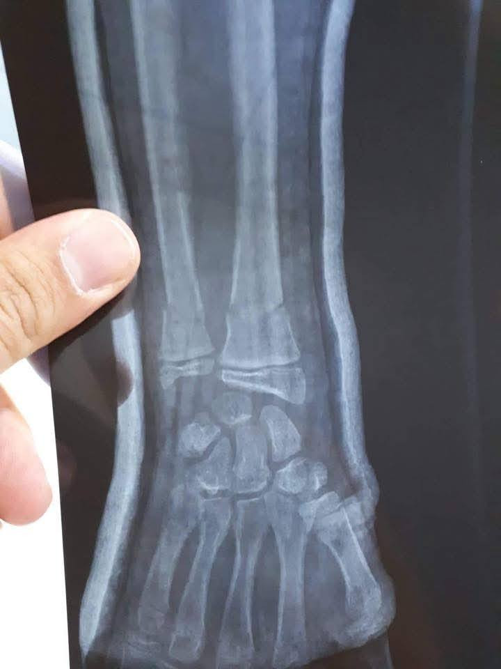 ⌛السلام عليكم⏳

سحب وتعديل لكسر معقد  بدون تداخل جراحي النتيجه 
الحمدلله  
                            الدكتور
                     ياسر يوسف العبيدي 
            اختصاص جراحة العظام والكسور 
البورد العربي( دكتوراه )جراحة العظام والكسور 
#كسور #تبديل_مفصل_الركبة #تبديل_المفصل_الورك #جراحةالعظام🦴_والمفاصل #جراحةالعظام #جراحة_العمود_الفقري #الانزلاق_الغضروفي #ناظور_الركبه #الاصابات_الرياضية #القدم_السكري
# متواجد في عيادته كل ايام الاسبوع عدا يوم الجمعه من الساعه 2:30مساء الي الساعه 5:00 مساء خلال شهر رمضان المبارك
 مجمع وصيدليه محمدسعيدحمدان 
للحجر والاستفسار ***********ك
هيت شارع الاطباء
