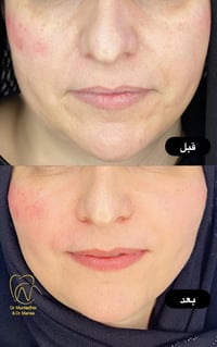 سحب وشد • د.مروة التميمي • تقسيط ماستر