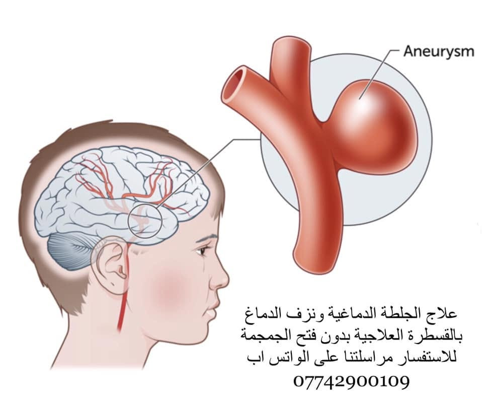 بفضل الله تعالى مستمرين باستقبال الحالات الطارئة من كافة محافظات العراق على مدار 24 ساعة لاجراء القسطرة الدماغيه التشخيصيه والعلاجية والتي تشمل حالات النزف الدماغي وحالات الجلطة الدماغية الخثرية بالاضافة الى حالات التشوهات الوعائية الدموية… والله الموفق 

الدكتور ظافر فيصل اعواجة 
اختصاصي جراحة وقسطرة الدماغ والعمود الفقري 
بغداد ساحة الواثق مركز ابن النفيس الطبي   
للحجز ***********
لارسال صور الرنين او المفراس والاستفسار  *********** واتساب 
#aneurysm
#stroke
#جلطة
