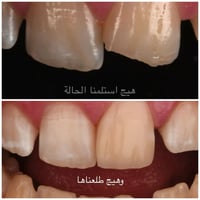 كسر اسنان امامية • علاج مجاني • شارع اربعين