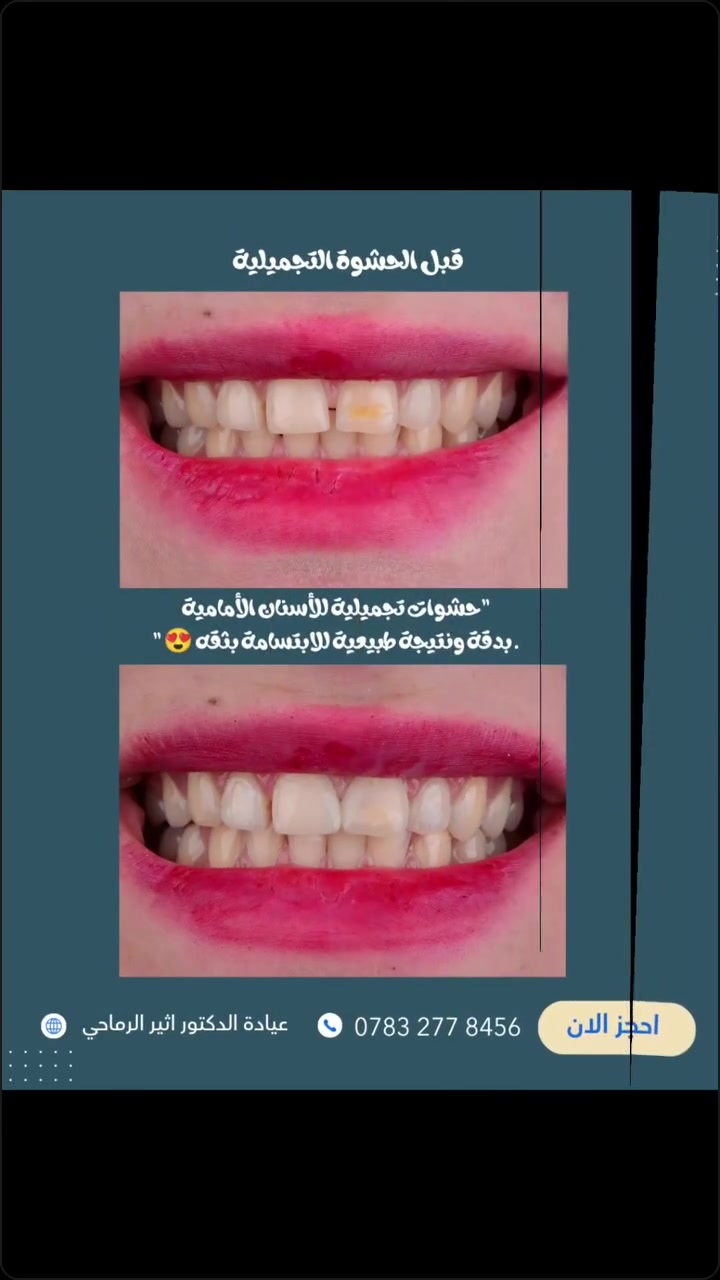 لمسة تجميلية دقيقة... وابتسامة تليق بك. 🤍
"تم إجراء حشوات تجميلية للأسنان الأمامية بدقة عالية لاستعادة جمال الابتسامة الطبيعي." ✨🦷

 (عيادة الدكتور أثير حليم الرماحي) 

 ☎️ للحجز والاستفسار ***********
او مراسلة الصفحة

📍 الموقع: 
الديوانية- قضاء عفك/شارع الأطباء قرب صيدلية أكرم البديري بناية الدكتورة مروة حمود التميمي الطابق الثاني

#ابتسامتك_تستحق_الأفضل #حشوات_تجميلية_للأسنان🦷
#اكسبلورexplore #قضاء_عفك #دكتور_أسنان
