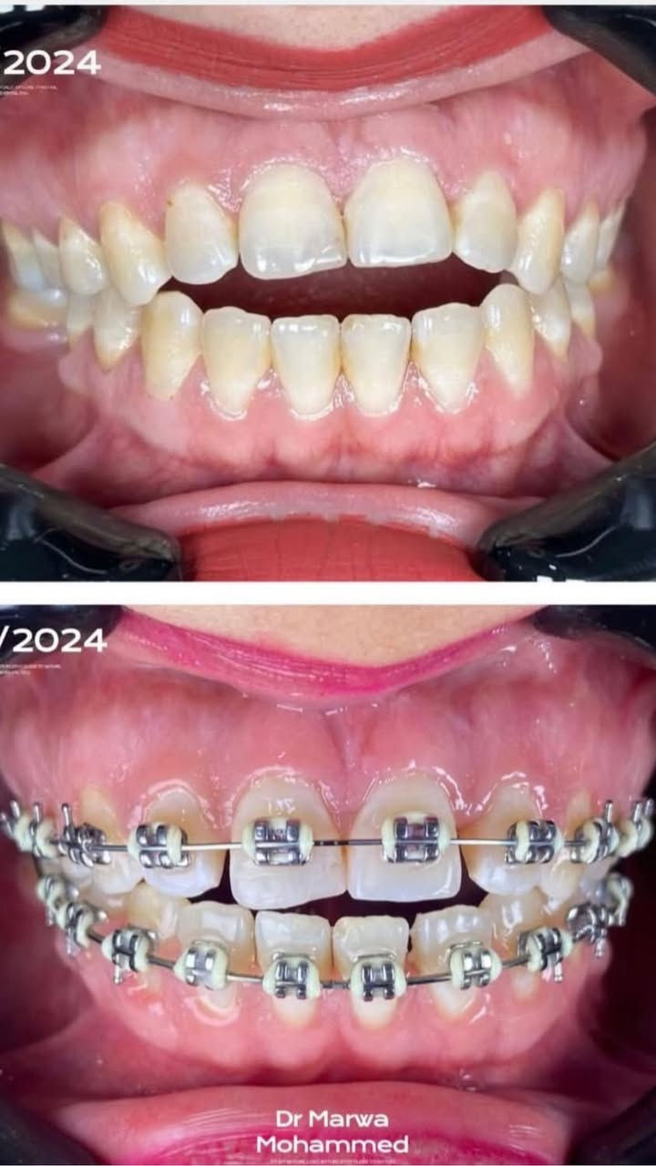 تقويم الأسنان 
د. مروة محمد طالب 
للتواصل ع الرقم
***********
