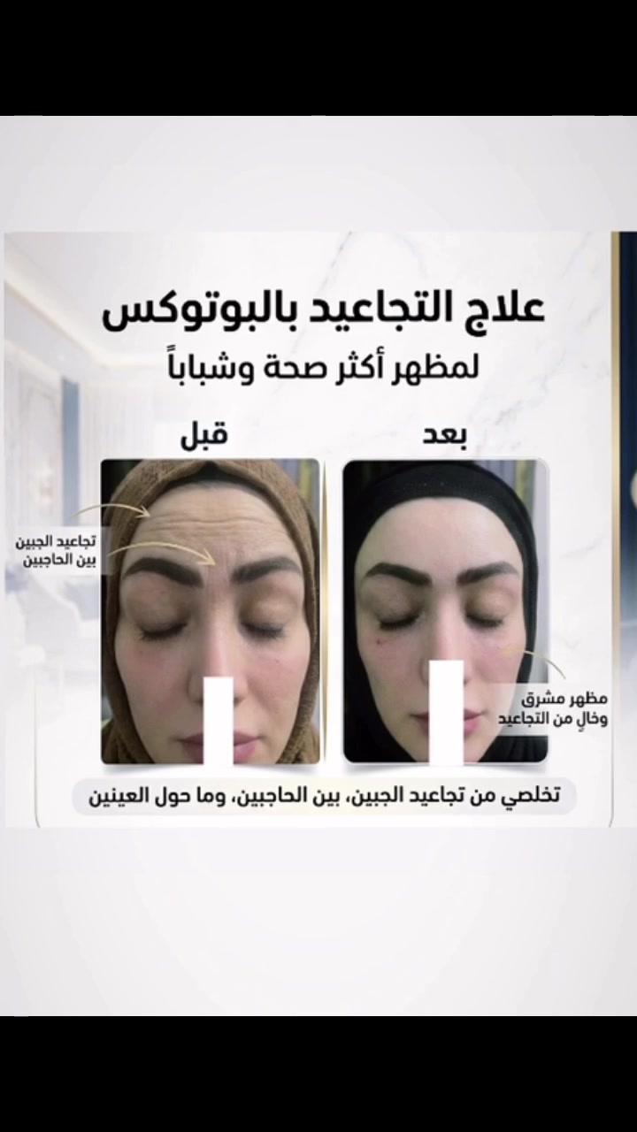 المركز السوري الطبي 
😍😍😍 😍😍😍نتيجه حقن البوتوكس لتجاعيد مابين الحاجب والجبهه وماحول العينين   💉🥼🩵 
كافة خدمات التجميل متوفرة بمركزنا ( للنساء والرجال )
وتحت أيادي أطباء اختصاص
متواجدين كل أيام الأسبوع 
المعاينة مجانا

جميع موادنا آمنه ومرخصة من وزاره الصحه 🤍
الدكتورة اريج هائل الحيدري ❤️❤️
#فلر #مدينة_الصدر #المحمودية
#المركز_السوري_الطبي
العنوان المحمودية تقاطع العزاب(المجمع) قرب مقر الفوج الثاني سابقاََ
للحجز والاستفسار مراسلة الصفحة أو الاتصال على الأرقام التالية 📱*********** ***********

