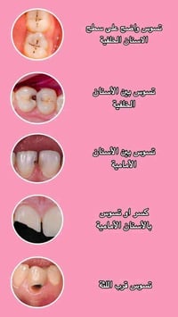 طب اسنان مجاني • طقم جزئي متحرك • الناصرية الجامعة الوطنية