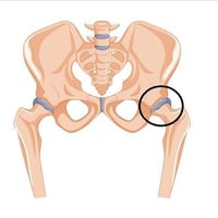 العلاج الطبيعي يلعب دور أساسي بعد خلع مفصل الفخذ، حيث يساعد على: ✅ تقل...