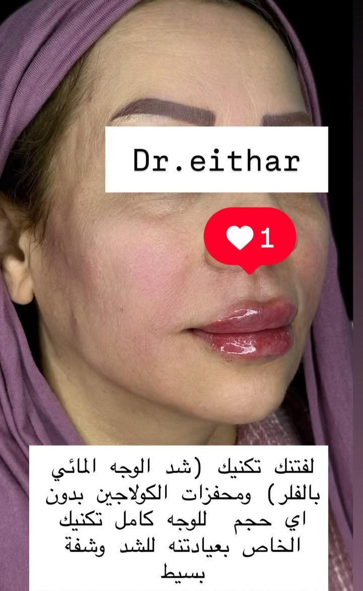 التغيير والشد والشفة ولاغلطة 🔥🔥🔥
استداره وجه كامله بطريقه الشد ولفتتك 🔥رفع وجنات والاصداغ وتدوير الفك والذقن✨وفلر  الشفة

بلشت عروووووض عيد الحب نزلتهه الكم بالستوري بالهايلايت وببوست اعلى الصفحة تبلش من باجر الخميس ✨
 
د.ايثار سامي عبد الامير
الكوت الهوره مجمع القبطان طابق اول قرب كوزمتك احمد باريس
الحجز***********
