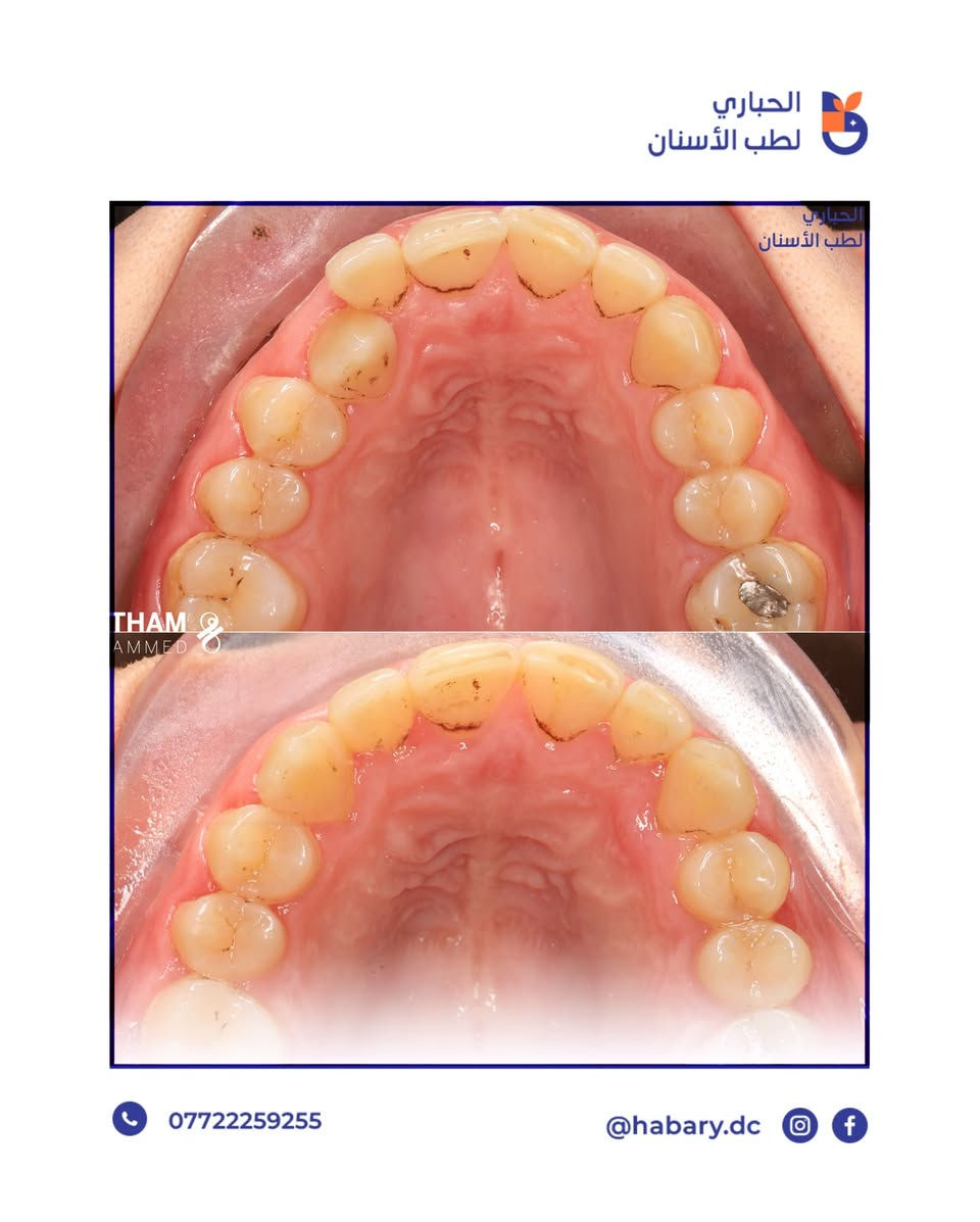 علاج العضة العميقة و تعديل إبتسامة مراجعة بتقويم الأسنان✨
المسيب - مجاور مركز صحي المسيب - مقابل مول فاملي المسيب- فوق مطعم سوبر صوص. 

رقم الحجز : ***********
