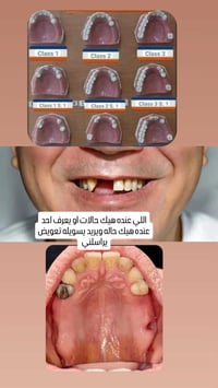 اللي محتاج تعويض لاسنانه يراسلني واتس 07728957299