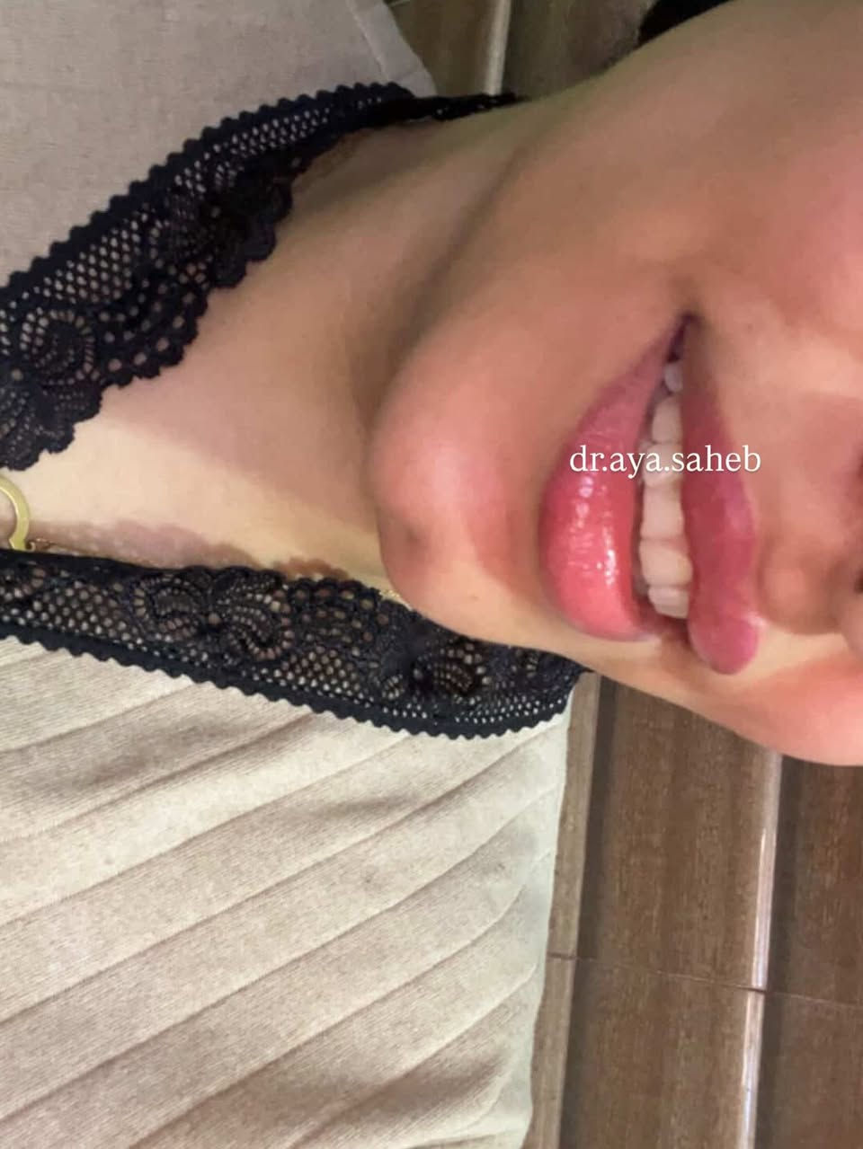 مجموعة صور مختلفة من مراجعاتي بعد حقن فلر الشفة ♥️ صورة احلى من صورة 🍬😍
للحجز والاستفسار/***********
الديوانية 📍
