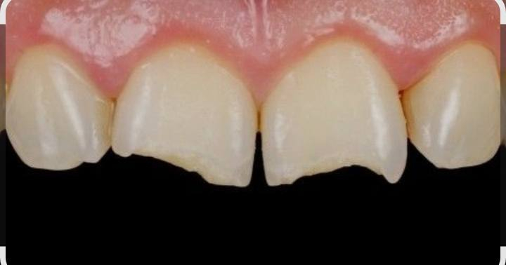 مرحبا الي عندة جذور متبقيه او كسر باسنانه الاماميه يتفضل بعيادات جامعة ابن سينا مقابل محطة وقود البياع العلاج مجاني يتصل ع الرقم *********** العيادة باجر
