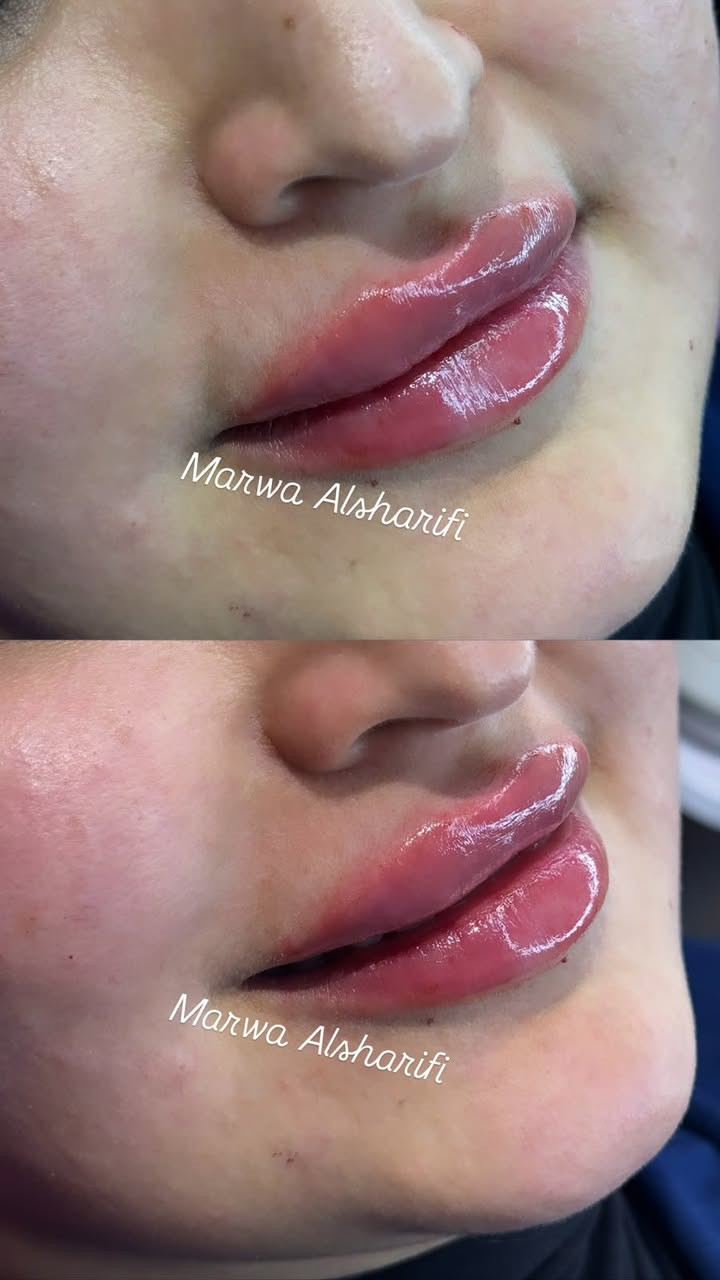 جمال المراجعة حبت تحقن فلر شفه الرجس ونضارة للبشرة من ايد مروة الشريفي😍


**إذا كنت صاحب هذا الإعلان وتريد حذفه لأي سبب، رجاءا أرسل رسالة إلى الدعم الفني**