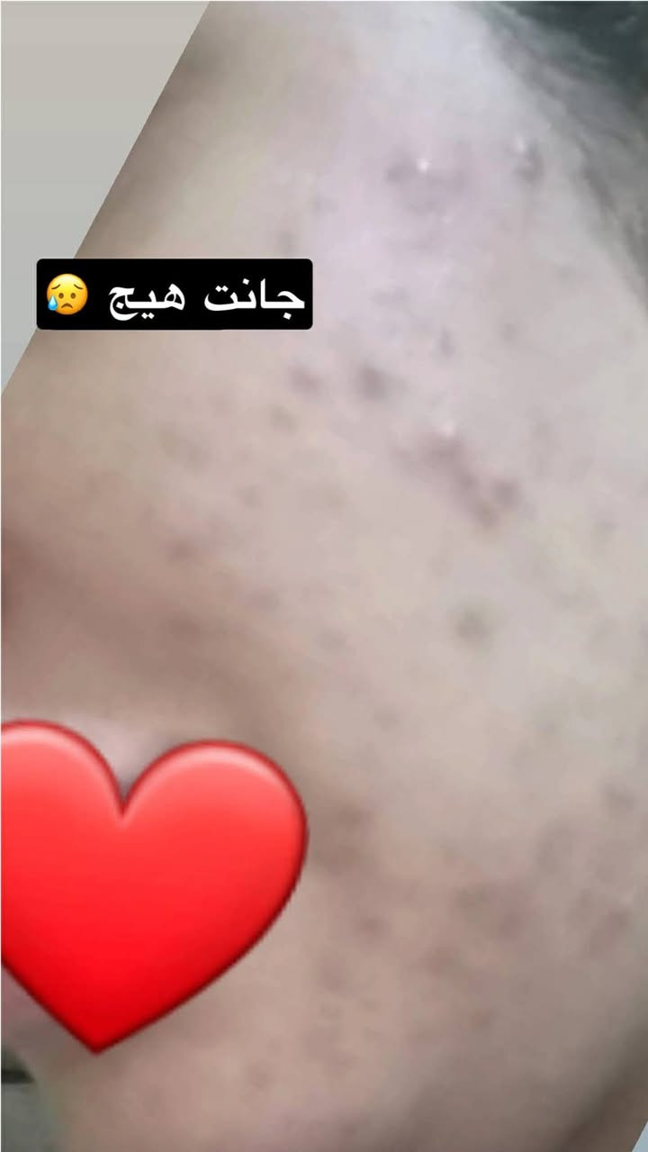 #خدود 
وتستمر خلطة ملامح بريئة بأثبات مفعولها بنتائج مبهرة 🫶  
معالجة شاملة مع تبيض نضاره توريد وتسمين 🌺


**إذا كنت صاحب هذا الإعلان وتريد حذفه لأي سبب، رجاءا أرسل رسالة إلى الدعم الفني**