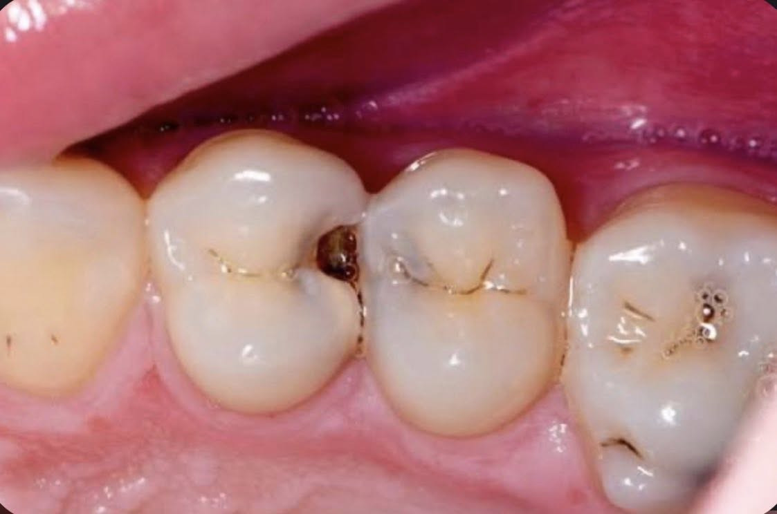 السلام عليكم
لمن لديه الحالات التالية من التسوس ويرغب في علاجها بسعر رمزي جدًا التواصل على الخاص أو الإتصال 
***********
