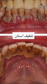 قلع مجاني • جامعة المنارة • بقايا جذور