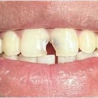 🦷✨ تعاني من تسوس أو كسر بالأسنان؟  حتى الحالات المتضررة بشدة نكدر نعال...