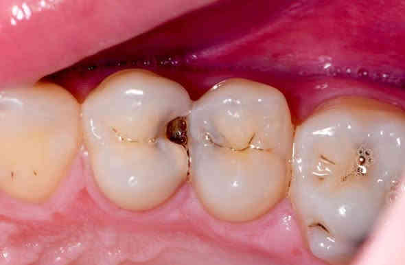 السلام عليكم: اي شخص عنده مثل هيج حالات مال التسوس ومحتاج حشوات ضوئية يتواصل وياي خاص او واتساب *********** علماً بأن العلاج مجاناً 🦷
