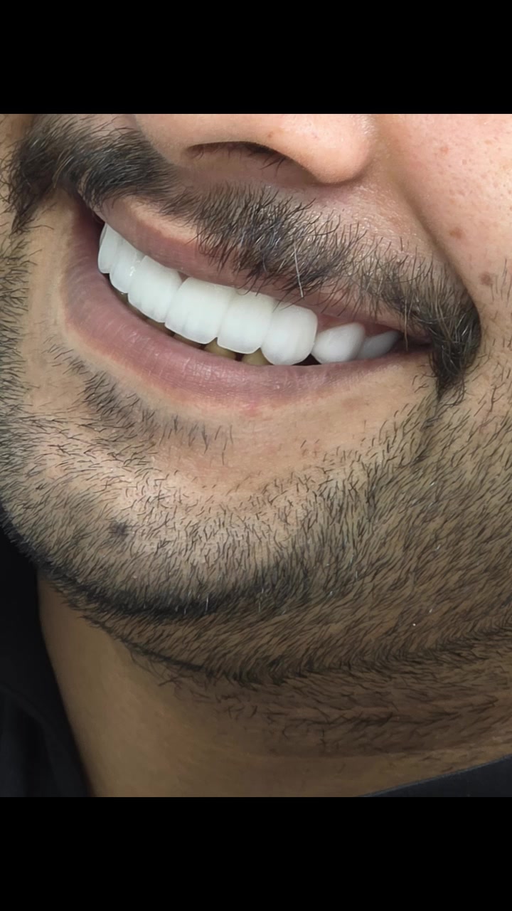 التميز الطبي في مركز الوارث يعني الدقة في التشخيص والمهارة في التنفيذ، لنضع بين يديك ابتسامةً تعكس رقيّك وجمال حضورك.
من اعمال طبيبنا المتميز 🫡
د محمد السخي


**إذا كنت صاحب هذا الإعلان وتريد حذفه لأي سبب، رجاءا أرسل رسالة إلى الدعم الفني**