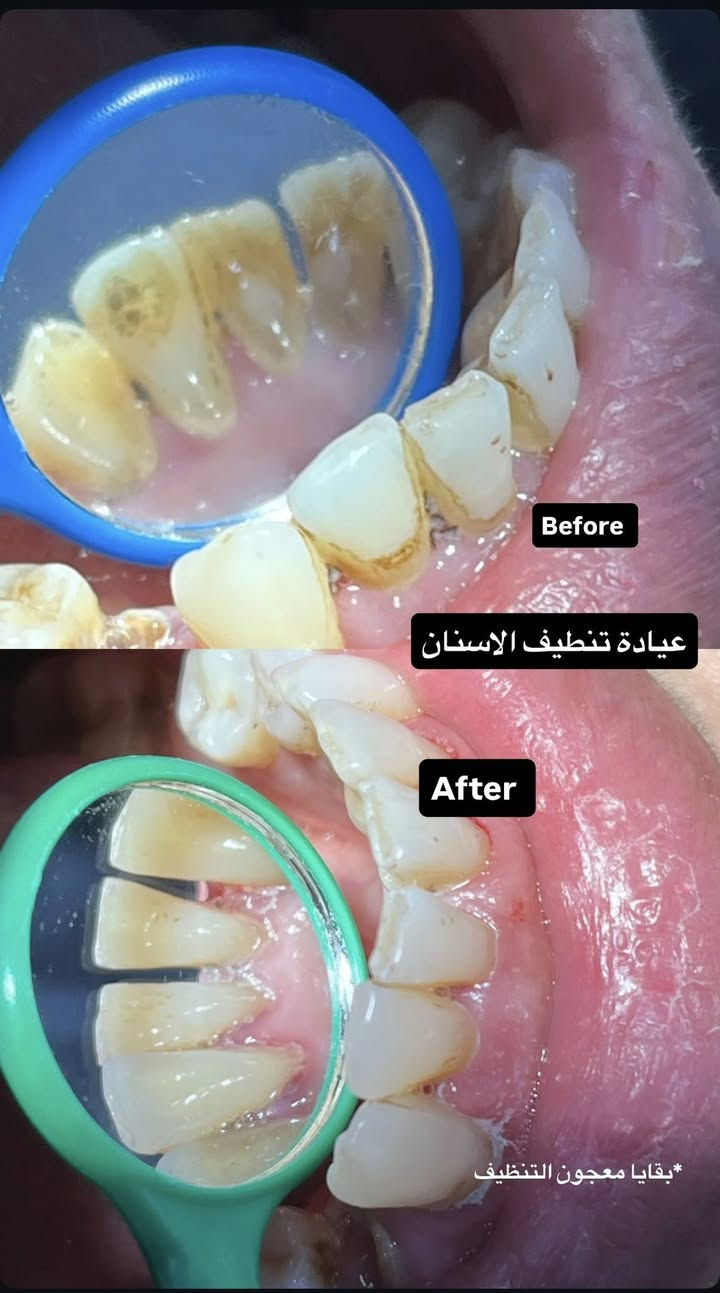 الي محتاج تنظيف اسنان او حشوات او تعويض اسنان بطقم متحرك يراسلني ع الواتساب  والشغل مجاناً 
***********
