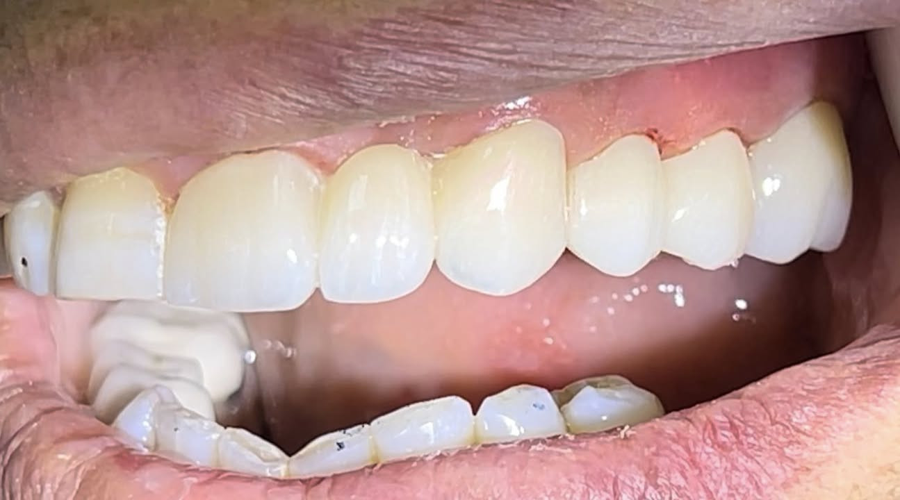 عيادة الطائي لطب الاسنان ♥️

باحدث التقنيات والطبعات الرقمية يتم تعويض الاسنان بتغليفات الزاركون المناسبة للكل شخص ✅

سارع بالحجز على الرقم *********** واتس اب

أو على الرقم *********** 

الموقع : سبع البور منطقة الـ 4000 قرب سوك الـ 4000 

عيادة الطائي لطب الاسنان

#سبعالبور #التاجيات #التاجي #سبع_البور
