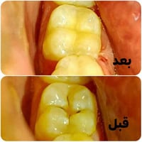 حشوة ضوئية • ضرس سفلي • الرمادي الصوفية