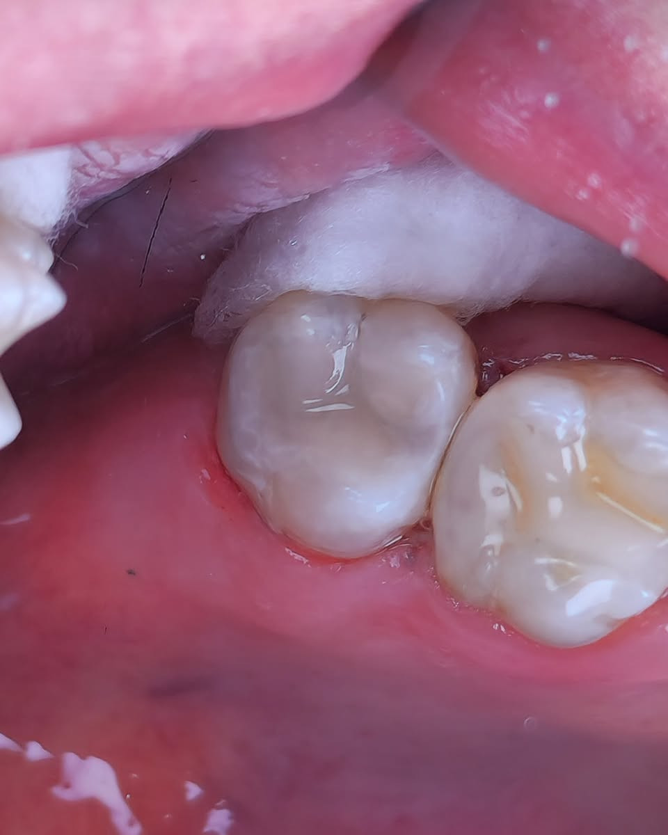 استبدال حشوة بلاتين قديمة بحشوة تجميلية بيضاء ✨
لوحظ وجود تغيّر بلون السن وتسوس مخفي تحت الحشوة المعدنية،
تمت إزالة الحشوة بالكامل وتنظيف التسوس بدقة،
واستبدالها بحشوة بيضاء تجميلية تعيد للسن لونه الطبيعي وقوته 💎
🔹 جلسة واحدة
🔹 بدون ألم
🔹 نتيجة طبيعية
للحجز والأستفسار راسلونا 📩
*********** 🟢📞 واتساب . 
#اسنان #طب_الاسنان #عيادة_اسنان #تجميل_الاسنان #حشوات  
Tokuyama Iraq
