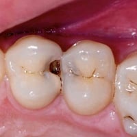 علاج اسنان مجاني • قلع اسنان • الجبيلة