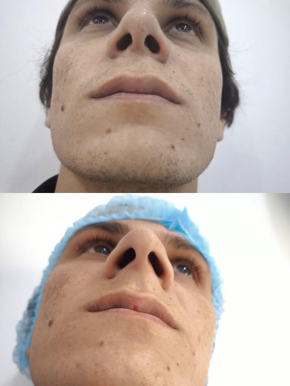 خشمك مو عاجبك؟ 🤔 ودك بملامح متناسقة تبرز جمالك؟ ✨ مركز الشرق الأوسط للتجميل يقدم لك الحل الأمثل! 🤩 عملية تجميل الأنف تخدير موضعي وبأيدي خبيرة الدكتور محمود أحمد! 💪🏻 بكلفة مناسبة جداً ٦٠٠ الف دينار بس! 🔥 للحجز والاستفسار‏ 078-132-88144‏
 اتصل بنا الآن! 📞 #تجميل_الانف #مركز_الشرق_الاوسط #الدكتور_محمود_احمد #تجميل #تنسيق_ملامح #جمال #عروض #تخفيضات #حجز_موعد #استشارة_طبية #بغداد #العراق #الجمال_العراقي"
