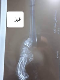 كسور معقدة • د ياسر العبيدي • هيت شارع الاطباء