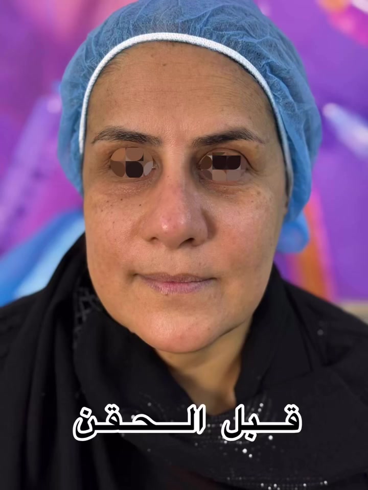 عروض عيد الفطر المبارك 
🎉🎉🎉🎉🎉🎉🎉🎉🎉🎉🎉🎉🎉🎉🎉🎉

                               على قسم التجميل
💝💝💝💝💝💝💝💝💝💝💝💝💝💝💝💝

 1️⃣ كل ٤  ابر فلر الابرة ٥ مجاناً
2️⃣ حقن شفة مع هدية بلازما وجه بالفيتامينات 
3️⃣ إبرة نضاره مع هدية تنظيف بشرة ملكي 
 4️⃣ بلازما مع هدية تنظيف بشرة 
5️⃣تنظيف بشرة عميق ١٥الف بدل ٢٥

✅ملاحظة:موادنا اصلية ومضمونة.

الدكتورة ايلاف عدنان 
الدكتورة يقين علي 

فرعنا الأول
#المركز_السوري_الطبي المحمودية حي البتول 
الفرع الثاني 
#مجمع_ترف_كلينك_الطبي مدينة الصدر قطاع ٧١

للحجز والاستفسار مراسلة الصفحة او الاتصال على الأرقام التالية ‭٠٧٧٤ ٤٩٩ ٤٦٦٤‬_ ‭٠٧٥٠ ٩٧٧ ٣٣٥٢‬

#تجميل #فلر #بوتوكس #بنات #مدينةنصر
